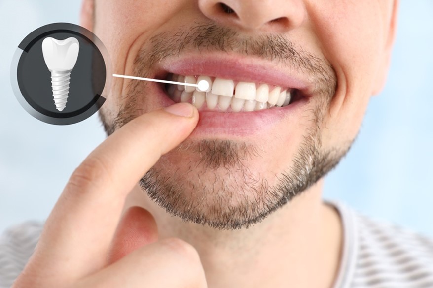 Implant dentaire sidi bennour dokkala Dr nabile lahna Chirurgien Dentiste