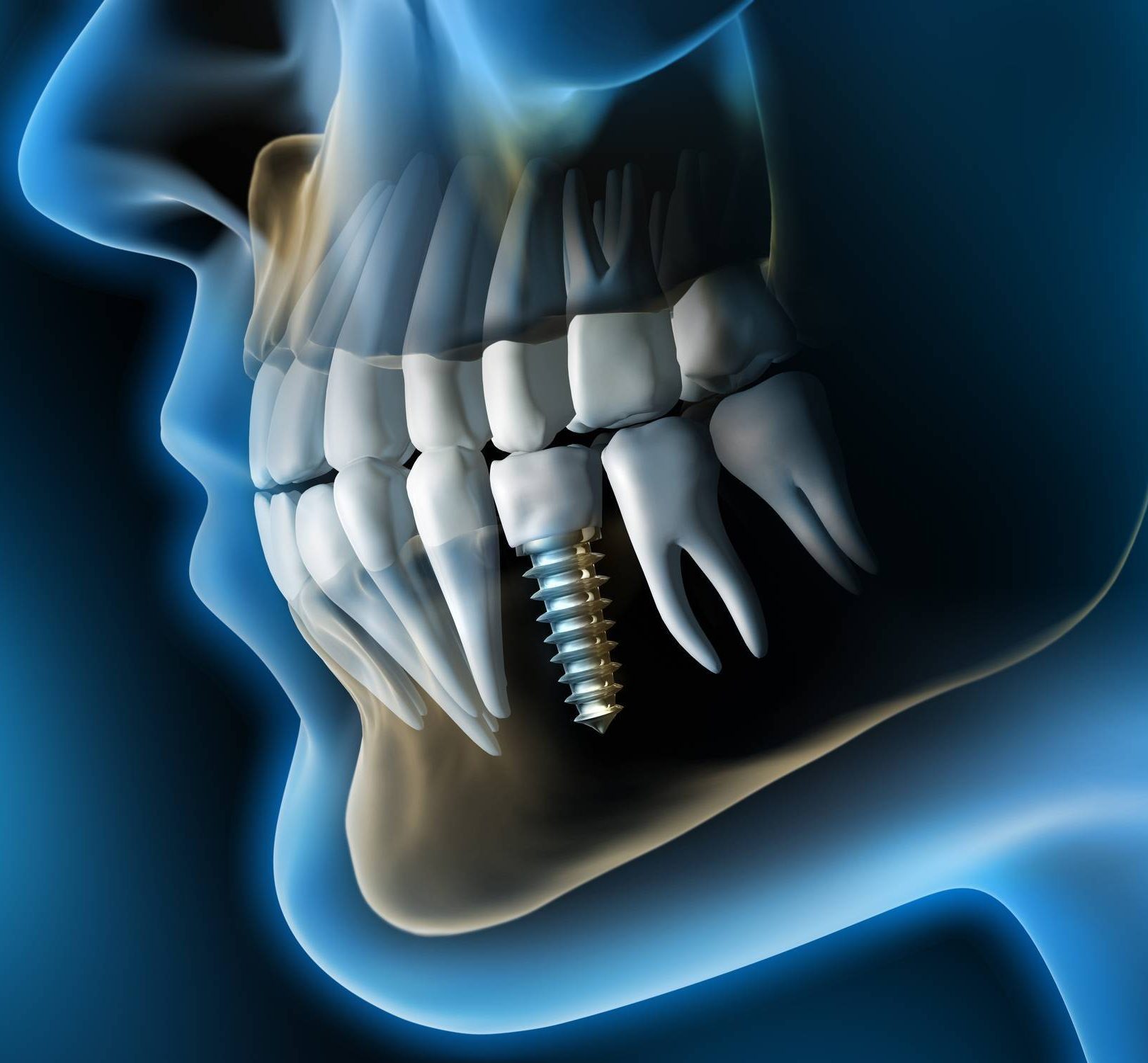 implant dentaire