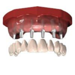 sidi bennour dentiste implant dentaire prothese dentaire total 1