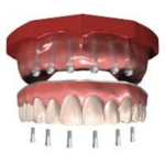 sidi bennour dentiste implant dentaire prothese dentaire total