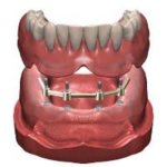 sidi bennour dentiste implant dentaire prothese dentaire total 2