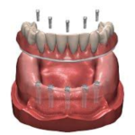 sidi bennour dentiste implant dentaire prothese dentaire total 3